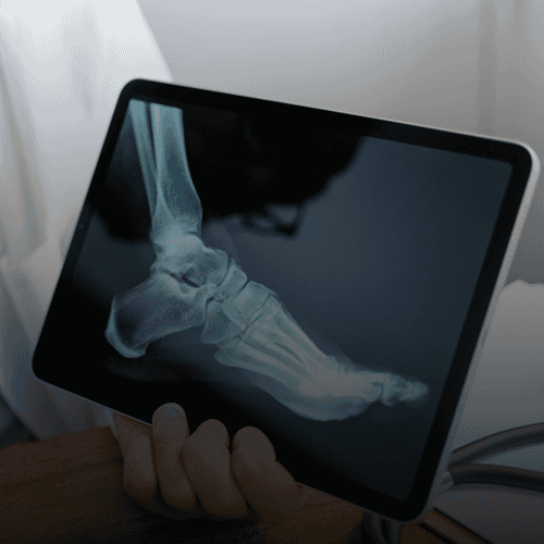 Orthopedic Surgery: Why Choose Cancun and Puerto Vallarta